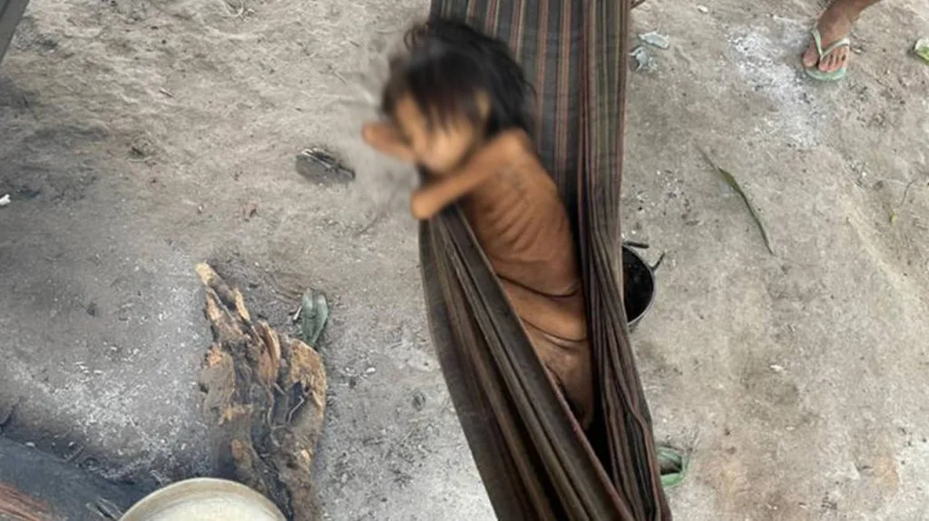  Desnutrição crônica: oito em cada 10 crianças Yanomami sofrem com deficiência nutricional